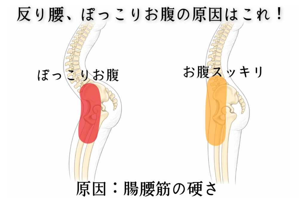 腸腰筋が硬いことによる骨盤の前傾を表した様子の図